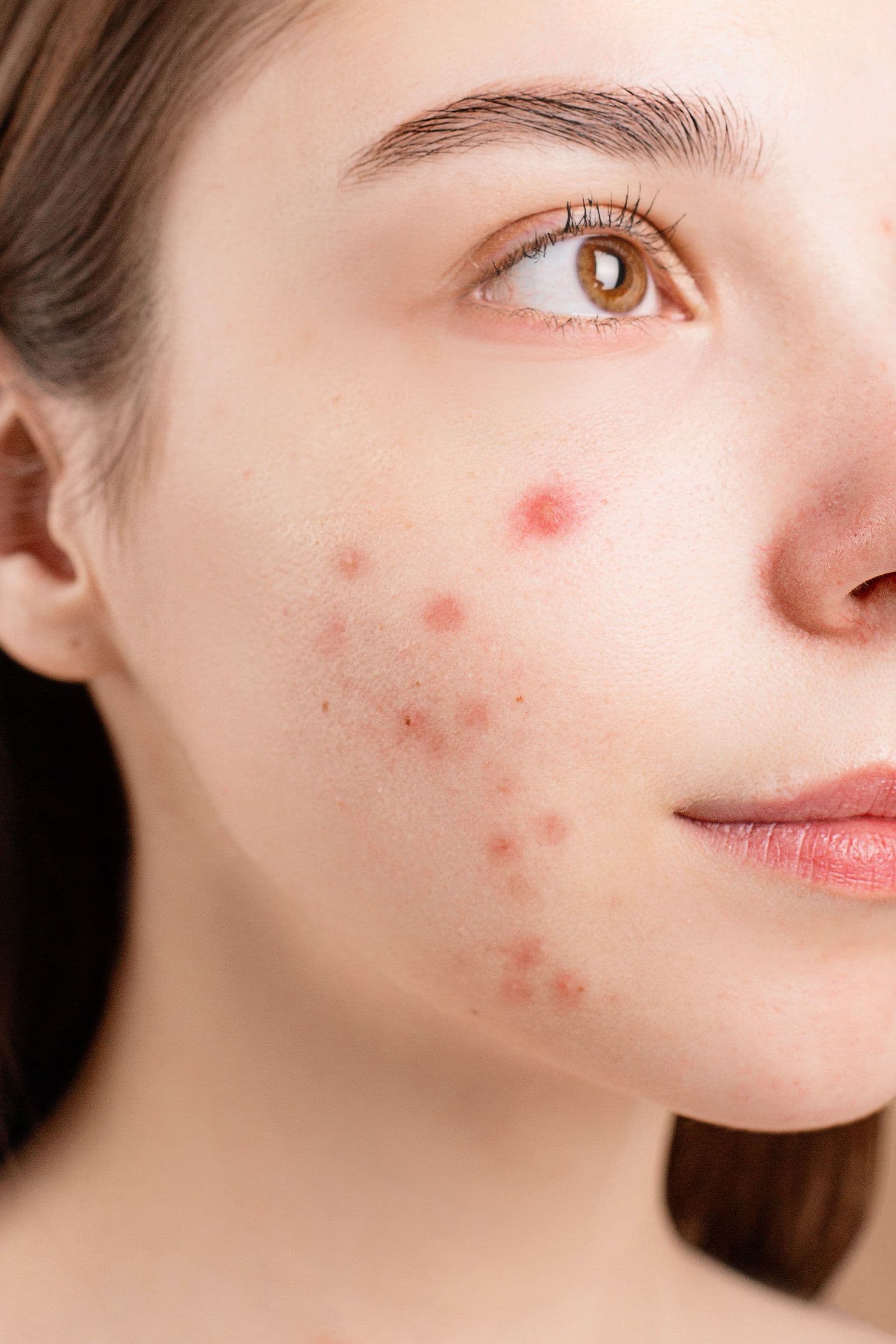 Pele oleosa e acne: o que realmente ajuda e o que é mito